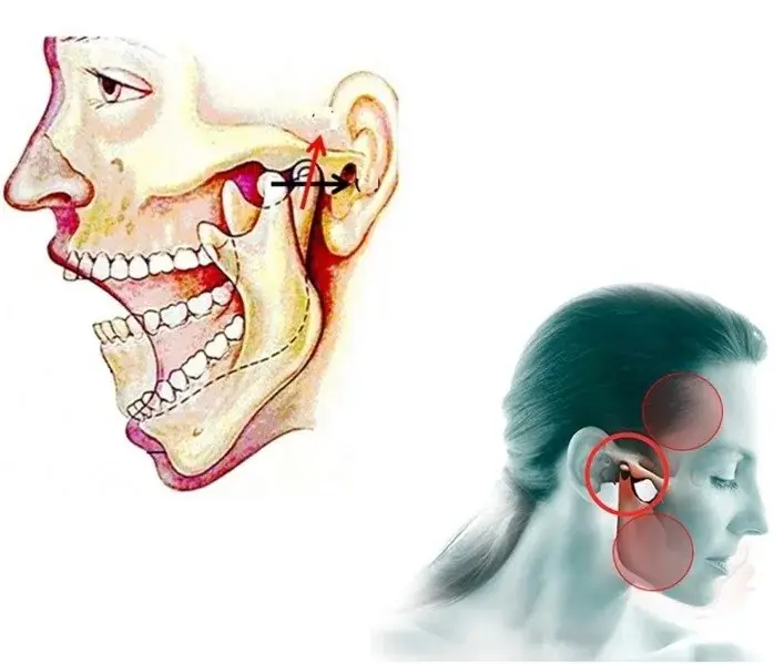 Terapias para el trastorno de la articulación temporomandibular (ATM)