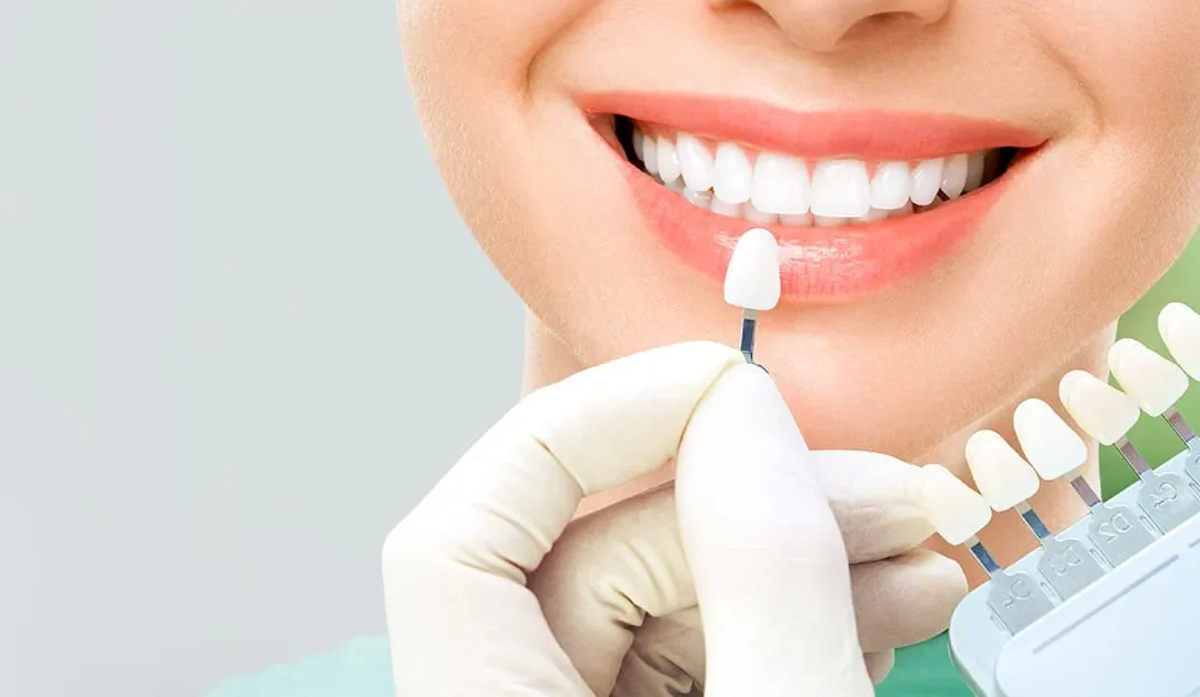 ¿Qué son las carillas dentales? Aprende todo sobre este tratamiento estético