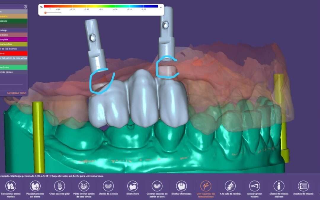 La última tecnología en implantología dental